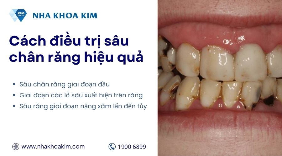 cách điều trị sâu chân răng
