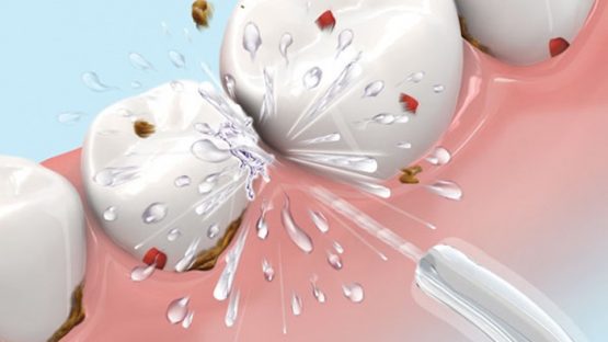 Cạo vôi răng sóng siêu âm – An toàn, hiệu quả cao, không gây ê buốt