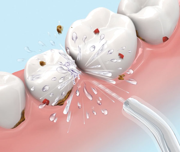 Cạo vôi răng sóng siêu âm - An toàn, hiệu quả cao, không gây ê buốt 1