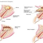 Phẫu thuật cắt chóp răng - Cho hàm răng luôn chắc khỏe Phẫu thuật cắt chóp răng - Cho hàm răng luôn chắc khỏe