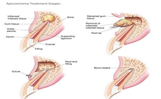 Phẫu thuật cắt chóp răng – Cho hàm răng luôn chắc khỏe
