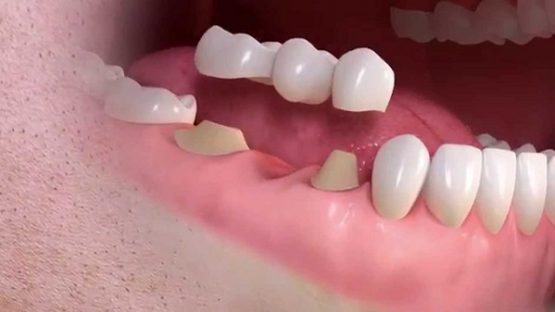 Cầu răng sứ – Phương pháp thay thế răng mất tiết kiệm, nhanh chóng