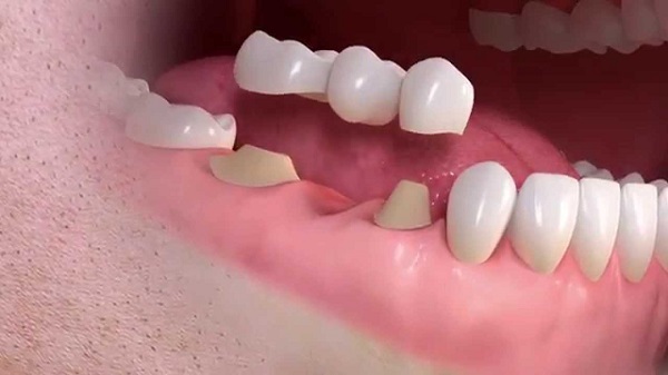 What is the cost of dental bridges made of titanium?