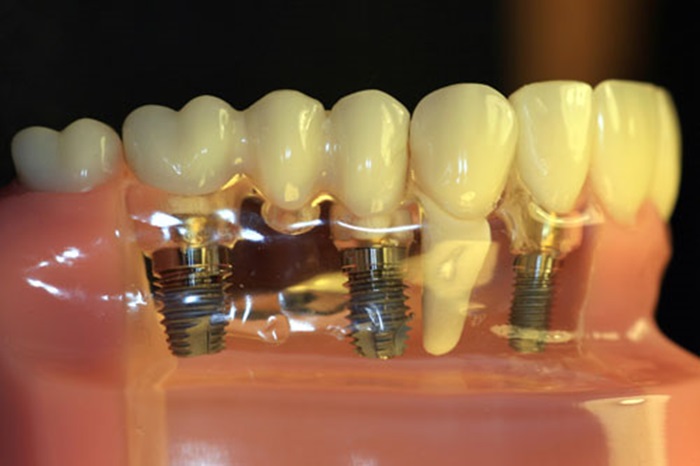 Cắm răng implant giá bao nhiêu tại Nha khoa KIM? 8