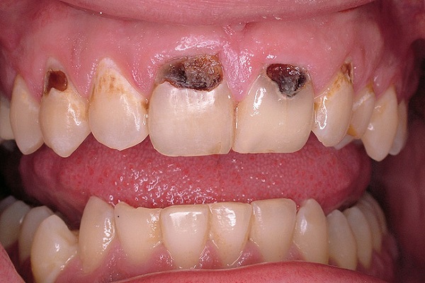 Nguyên nhân nào gây sâu chân răng?