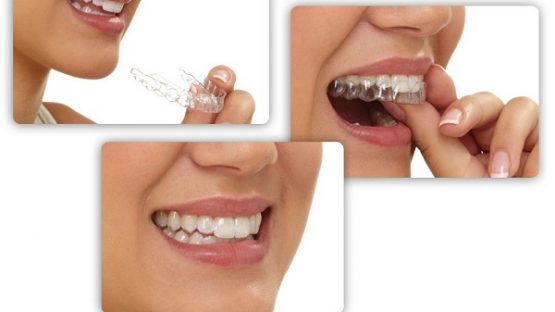 Niềng răng invisalign – Giải pháp chỉnh nha an toàn, thẩm mỹ cao