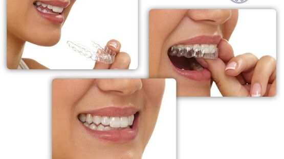Niềng răng Invisalign – Giải pháp chỉnh nha an toàn, thẩm mỹ cao