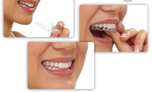 Niềng răng Invisalign – Giải pháp chỉnh nha an toàn, thẩm mỹ cao