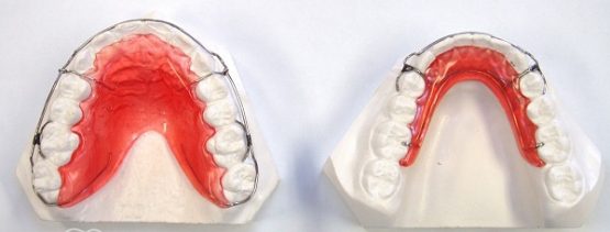Chỉnh nha tháo lắp là gì? Có tác dụng như thế nào?