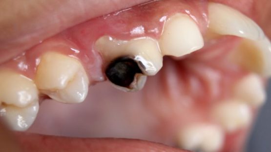 Trám răng bị đen – Giải pháp nhanh chóng cho hàm răng trắng đẹp như ý