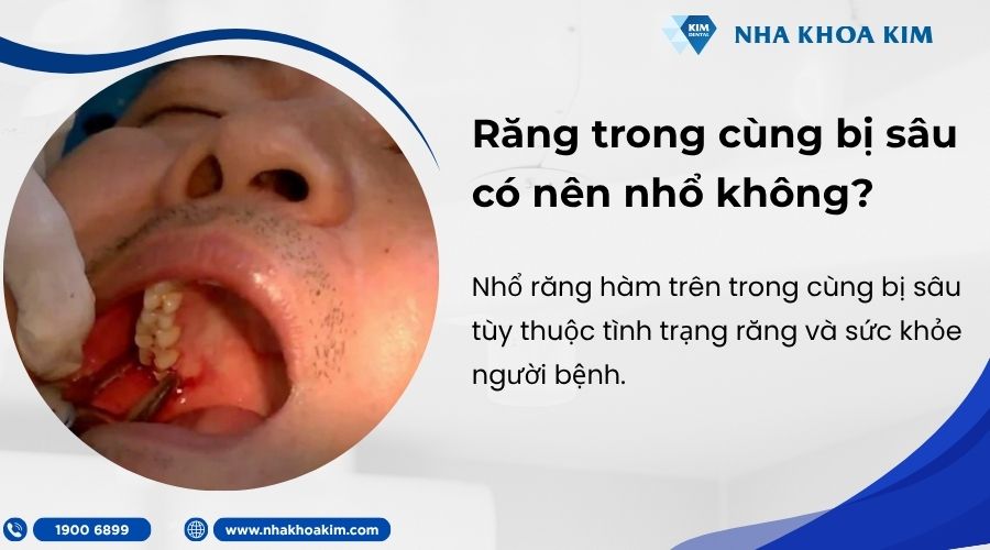 Răng trong cùng bị sâu có nên nhổ không?
