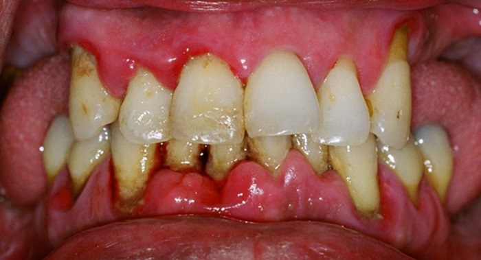 Viêm nha chu răng là gì?