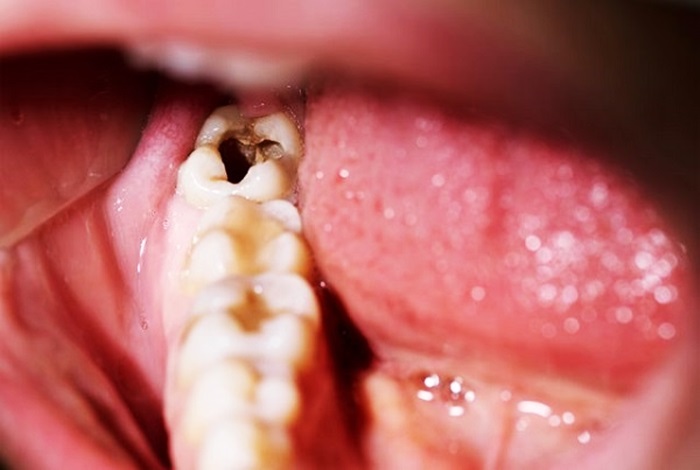 Sâu răng hàm dưới điều trị bằng cách nào hiệu quả nhất? 1