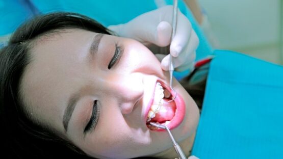 Niềng răng mắc cài 3M – Những thông tin “kinh điển” cần biết