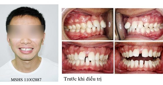 Niềng răng cửa – Giải pháp hoàn hảo cho răng hô, vẩu, thưa, lệch lạc
