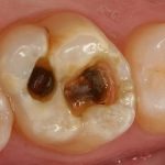 Điều trị tủy răng an toàn bằng công nghệ vi phẫu mới tân tiến Điều trị tủy răng an toàn bằng công nghệ vi phẫu mới tân tiến