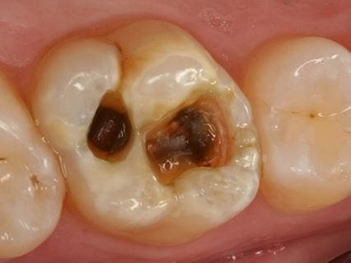 Điều trị tủy răng an toàn bằng công nghệ vi phẫu mới tân tiến 1
