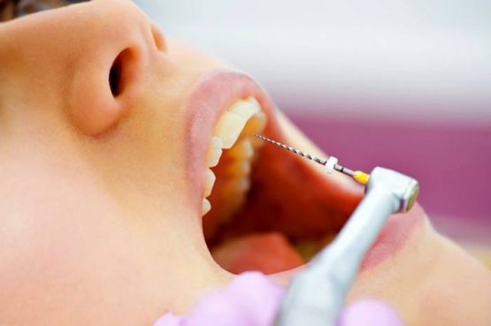 Điều trị tủy có đau không? Điều trị tủy răng tại Nha Khoa Kim