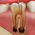 Điều trị tủy răng và những thông tin hữu ích bạn cần biết Điều trị tủy răng và những thông tin hữu ích bạn cần biết
