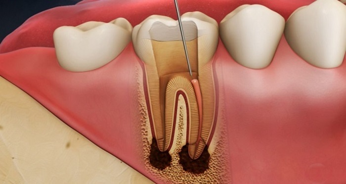 Điều trị tủy răng giá bao nhiêu tiền, có mất nhiều chi phí không? 1