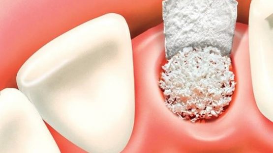 Ghép xương trồng răng Implant – Tất tần tật những thông tin bạn cần biết