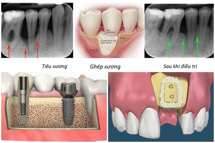 Cấy ghép implant sớm sẽ giúp ngăn chặn tình trạng mất xương, co rút nướu