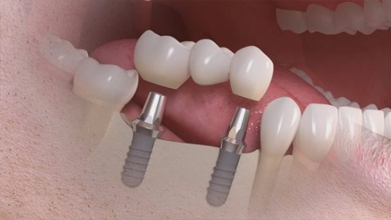 Bọc răng sứ Implant – Giải pháp khôi phục răng đã mất tối ưu nhất