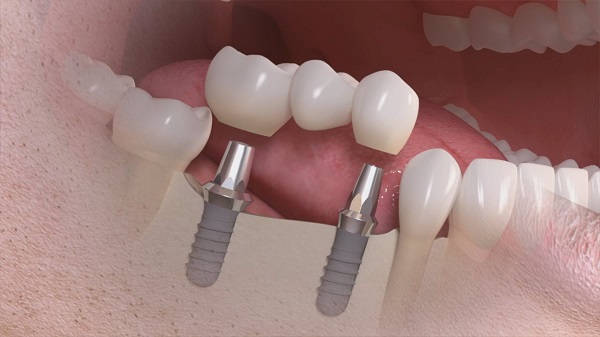 Tất cả những điều cần biết về răng sứ implant 
