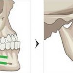 Giá phẫu thuật hàm móm bao nhiêu tiền? | Thông tin giải đáp Giá phẫu thuật hàm móm bao nhiêu tiền? | Thông tin giải đáp