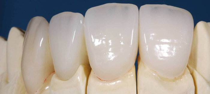 Thực hư phương pháp phục hình răng sứ không mài răng  nhakhoathuyanh