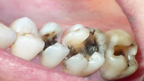 Sâu răng hàm dưới điều trị bằng cách nào hiệu quả nhất?