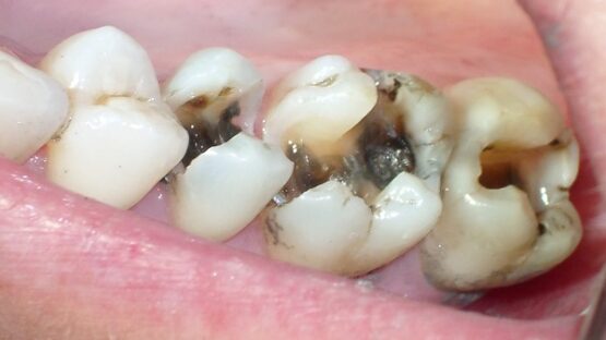 Sâu răng hàm dưới điều trị bằng cách nào hiệu quả nhất?