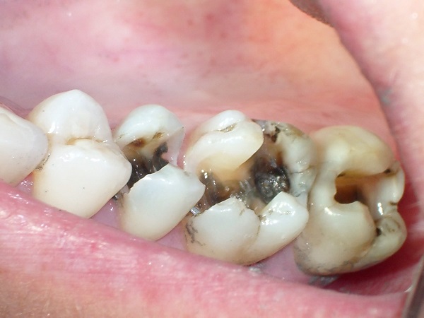 Các triệu chứng chính khi bị sâu răng hàm là gì?
