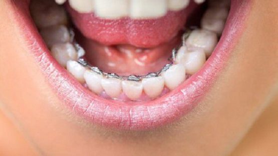 Niềng răng hàm dưới có tốt không?