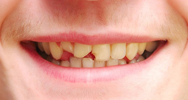 Hạn chế của hàn răng mẻ là gì?

