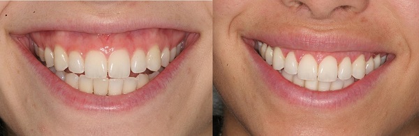 Hình ảnh khách hàng điều trị cười hở lợi tại Nha Khoa Kim 1