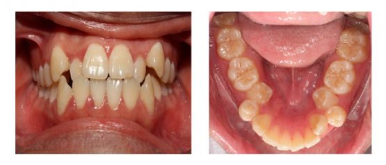 Nhổ răng nanh an toàn không biến chứng tại Nha Khoa Kim