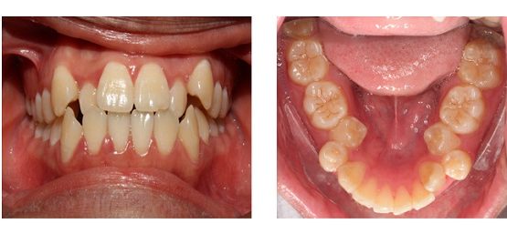 Nhổ răng nanh an toàn không biến chứng tại Nha Khoa Kim