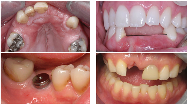 Những trường hợp nên trồng răng implant Trồng răng implant - Sở hữu răng mới bền đẹp như răng thật -1
