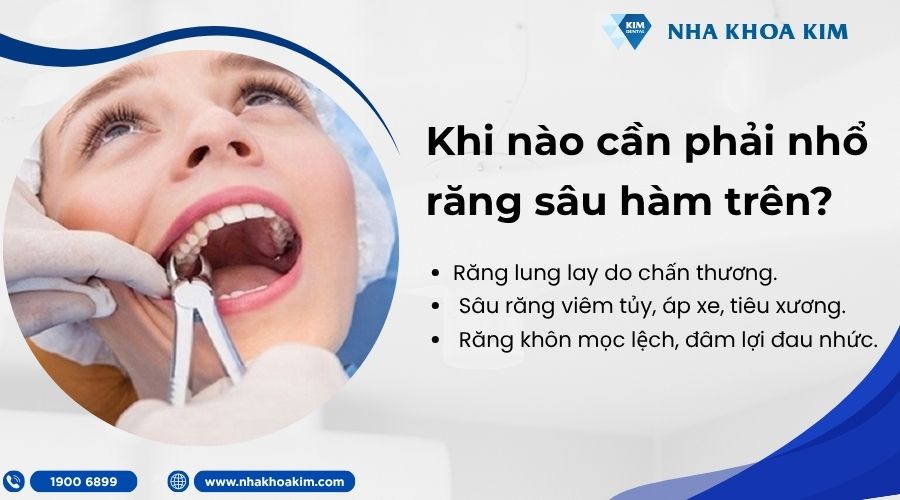 Khi nào cần phải nhổ răng sâu hàm trên?