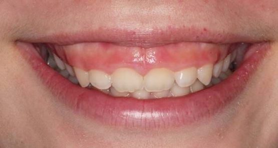 Phương pháp làm răng dài nào được áp dụng phổ biến hiện nay?