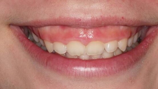 Phương pháp làm răng dài nào được áp dụng phổ biến hiện nay?