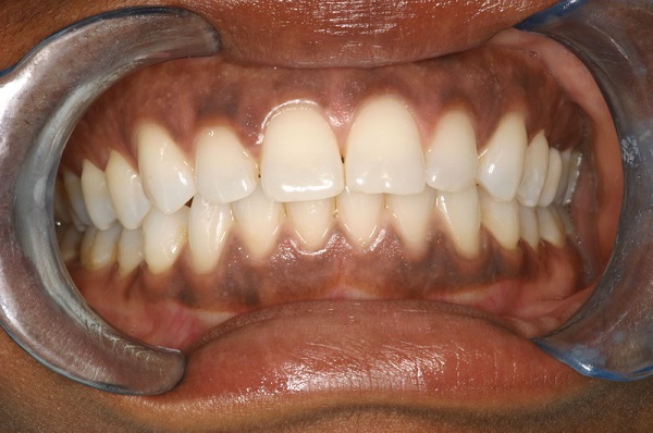 Có những biểu hiện nào khác cần chú ý nếu bạn có răng bị thâm đen? 
