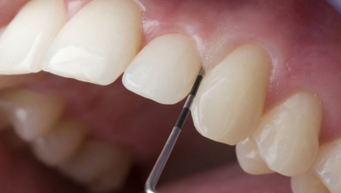 Có nên bọc răng sứ hay không? Bọc răng sứ có tốt như lời đồn?