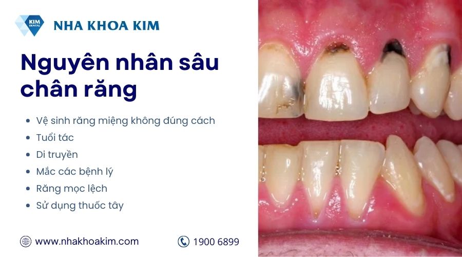 nguyên chân gây sâu chân răng