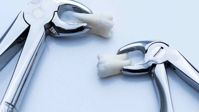 Răng trong cùng - Nên nhổ bỏ hay điều trị để bảo tồn răng? 2