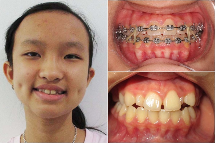 trẻ em điều trị răng tại Nha Khoa Kim