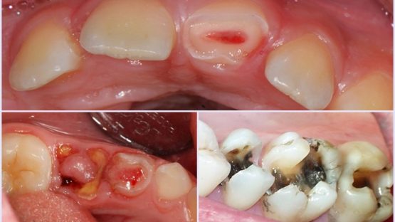 Nhổ chân răng có ảnh hưởng gì tới cấu trúc hàm không, có đau không