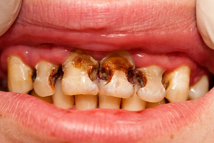 sâu răng sửa