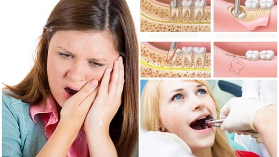 Nhổ răng mọc lệch hàm trên an toàn, không đau tại Nha khoa Kim